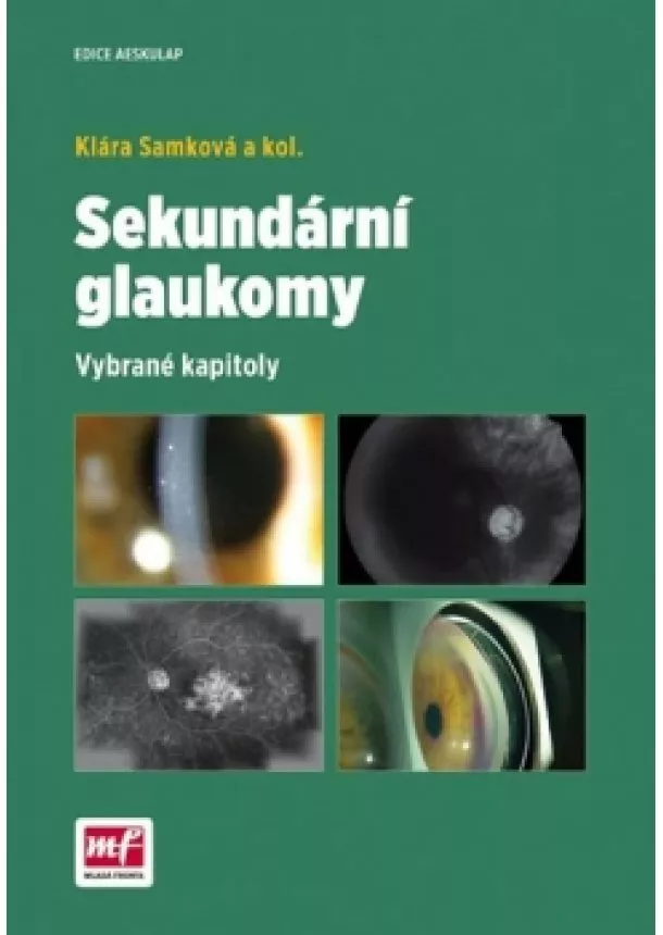 Klára Samková - Sekundární glaukomy