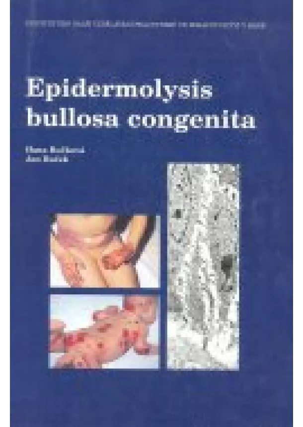 Hana Bučková, Jan Buček - Epidermolysis bullosa congenita