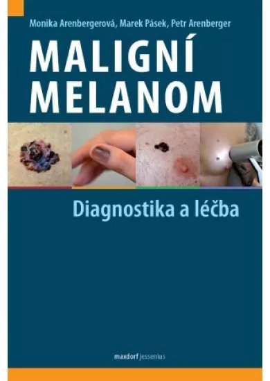 Maligní melanom - Diagnostika a léčba